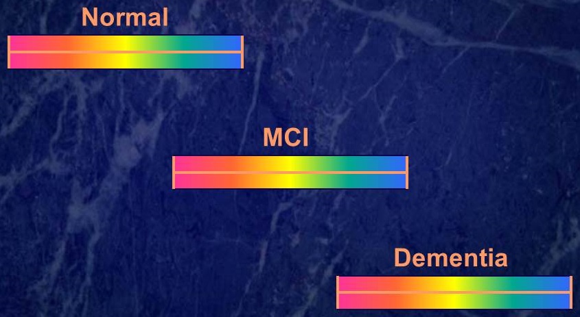 Brain wave diagrams: Normal, MCI, and Dementia.