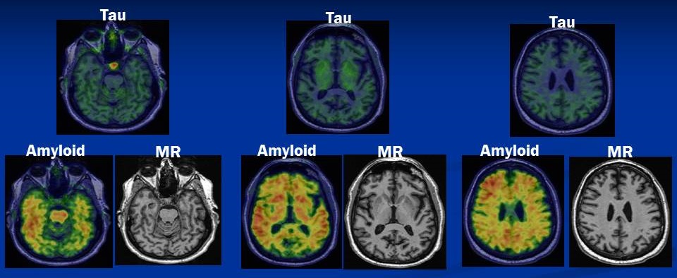 Screen Shots of Brain Tau, Amyloid and MR scans.