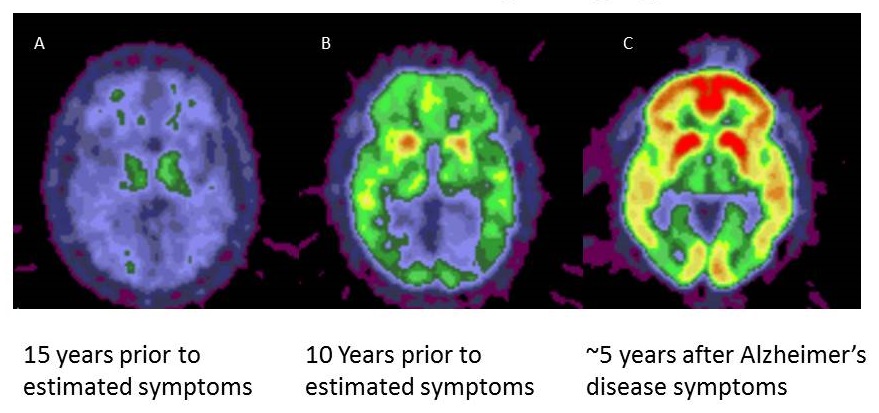 Screen shot of several brain scans: 15 and 10 years prior to symptoms, and 5 years after AD symptoms.