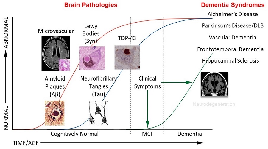 Illustration of Alzheimer's progression.