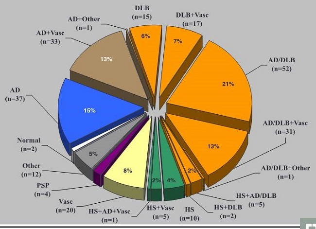 Pie chart: Normal (n=2); AD (n=37, 15%); AD/DLB (n=52, 21%); AD+Vasc (n=33, 13%); AD/DLB+Vasc (n=31, 13%); DLB (n=15, 6%); DLB+Vasc (n=17, 7%); Vasc (n=20, 8%); HS (n=10, 4%); HS+Vasc (n=5, 2%); HS+DLB (n=2); HS+AD/DLB (n=5, 2%); HS+AD+Vasc (n=1); PSP (n=4); Other (n=12, 5%); AD+Other (n=1); AD/DLB+Other (n=1).