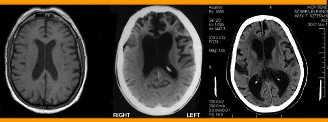 MRIs of brain.