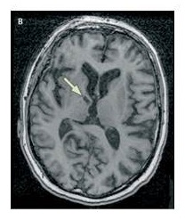 MRI of brain.