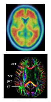 MRI of brain.