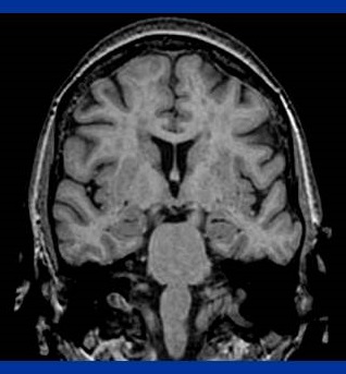 Photo of brain MRI.