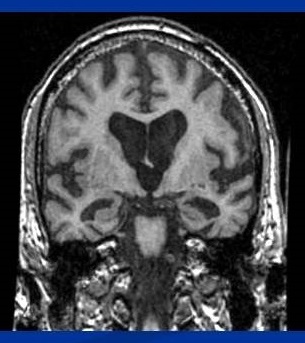 Photo of brain MRI.