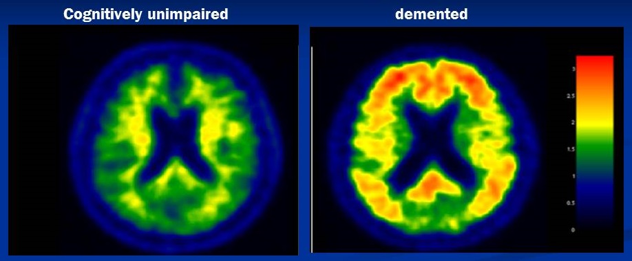Screen Shots of Brain PET scans--Cognitively unimpaired versus demented.