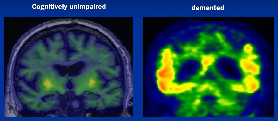 Screen Shots of Brain PET scans--Cognitively unimpaired versus demented.