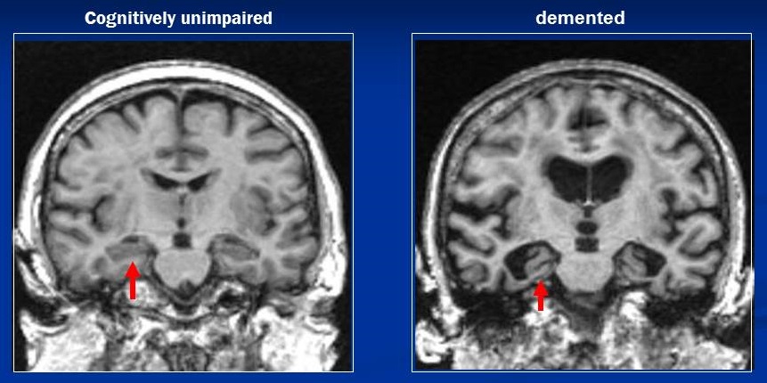Screen Shots of Brain MRI scans--Cognitively unimpaired versus demented.