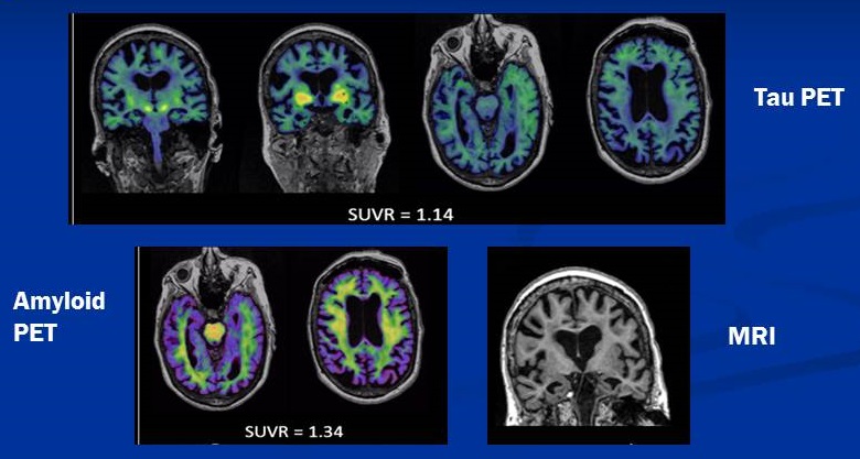 Screen Shots of Brain Tau, Amyloid and MR scans.